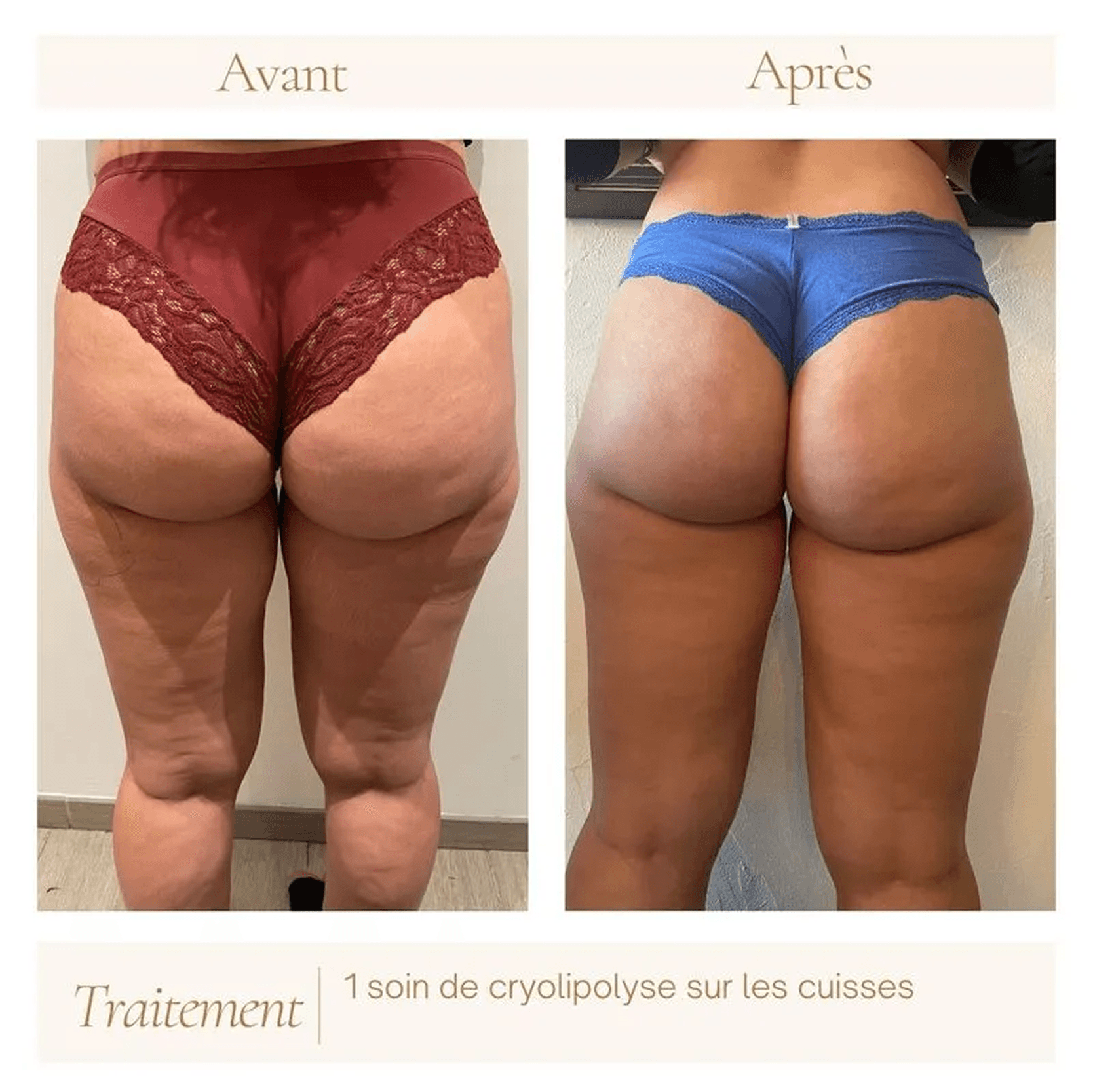 Cuisses avant une séance de cryolipolyse — photographie du cabinet